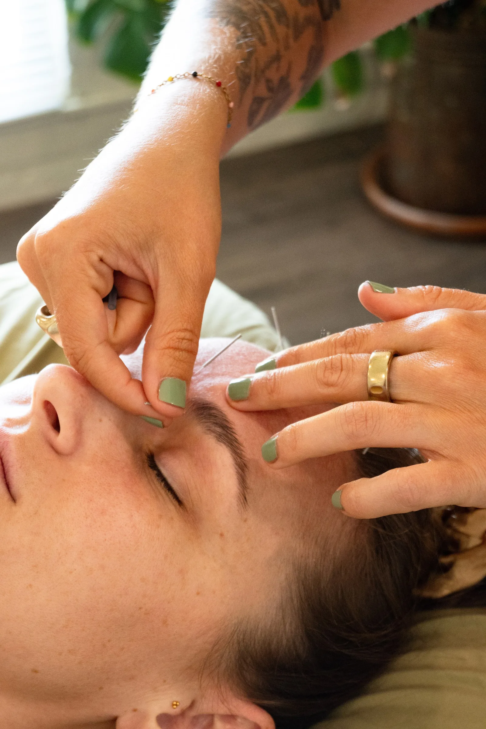 A practitioner carefully placing a facial acupuncture needle