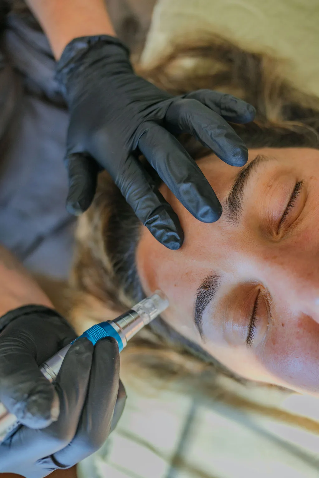 Close-up of microneedling treatment on the forehead